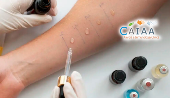 Clínica CAIAA - 30% Pruebas cutáneas de alergia.